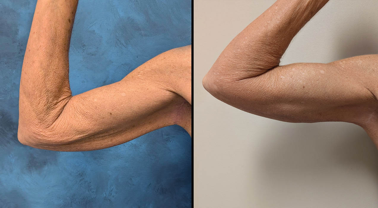 brachioplasty before and after